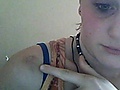 bite marks